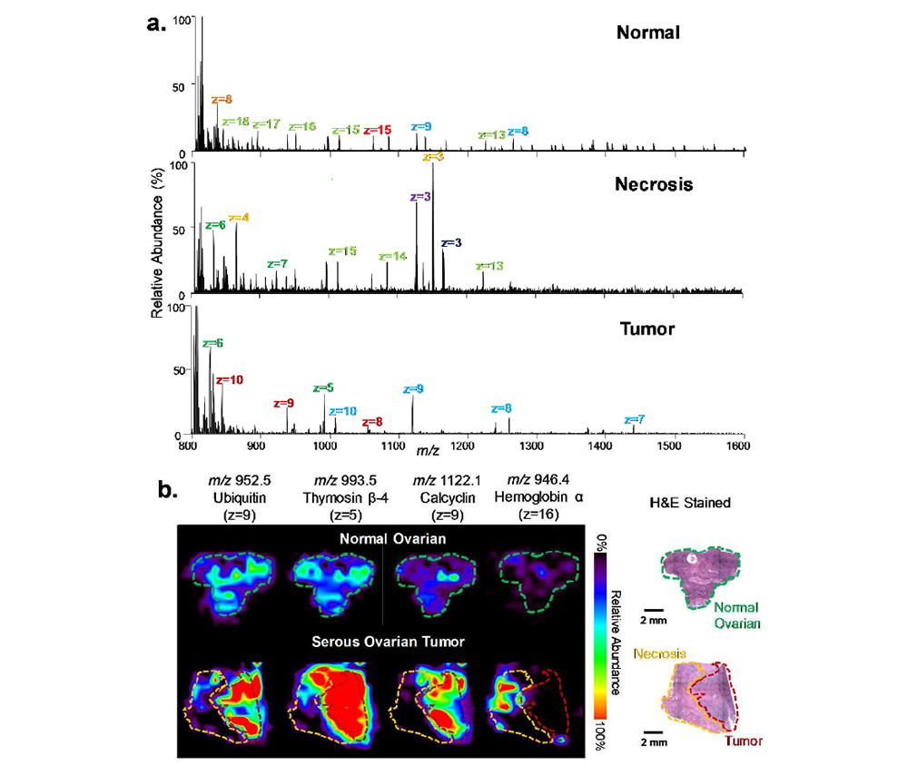 LMJ-SSP-FAIMS-MS profiling and imaging of human normal and cancerous ovarian tissues