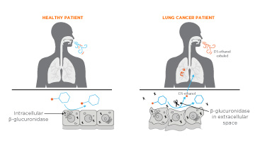 Owlstone Medical Recruits First Patient in Phase 2 Clinical Trial for the Early Detection of Lung Cancer through Breath Biopsy®