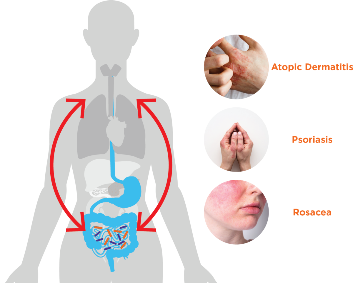 How the Gut Microbiome Influences Skin Health: Exploring the Gut-Skin Axis