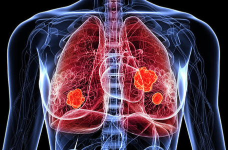 Lung Cancer Associated VOCs