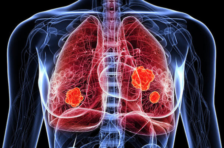 lung cancer blog thumbnail