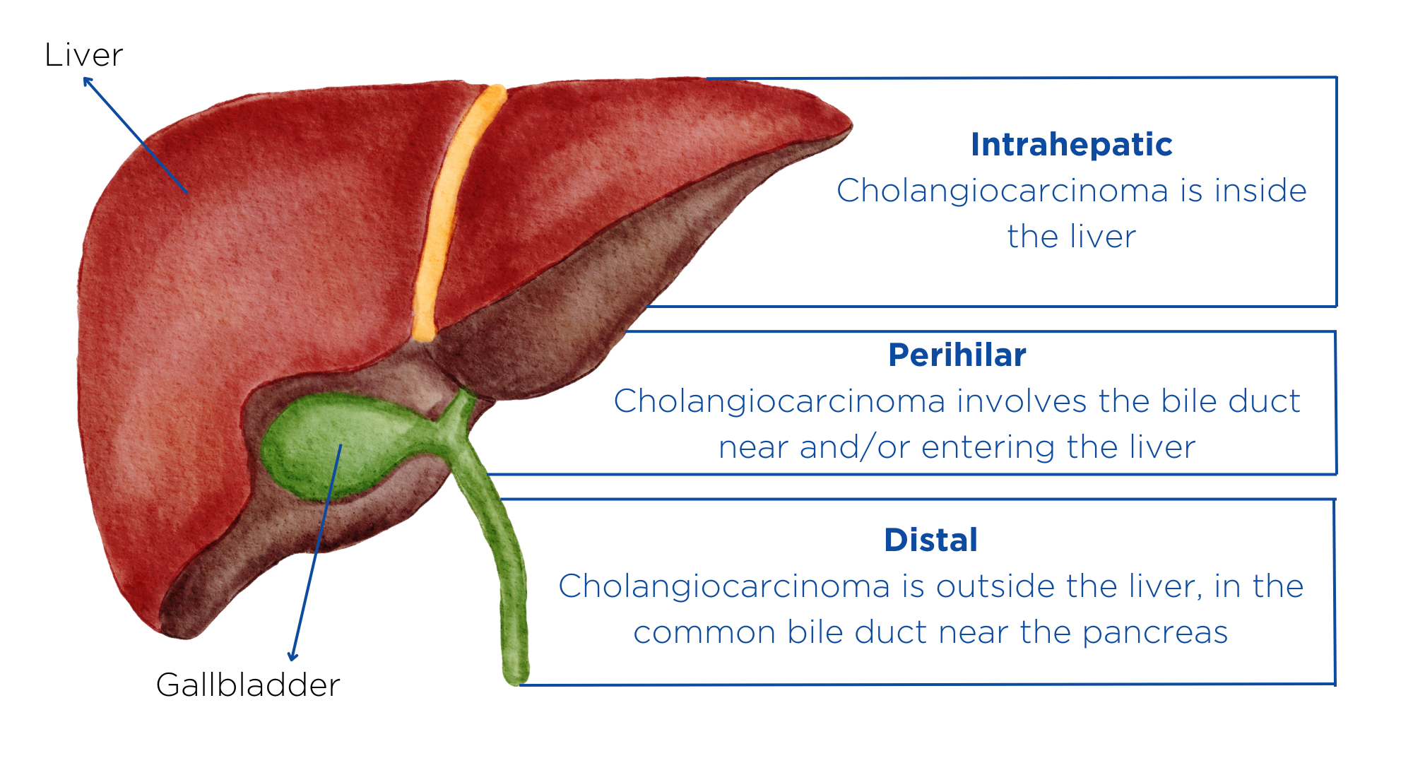 PerihilarCholangiocarcinoma graphic