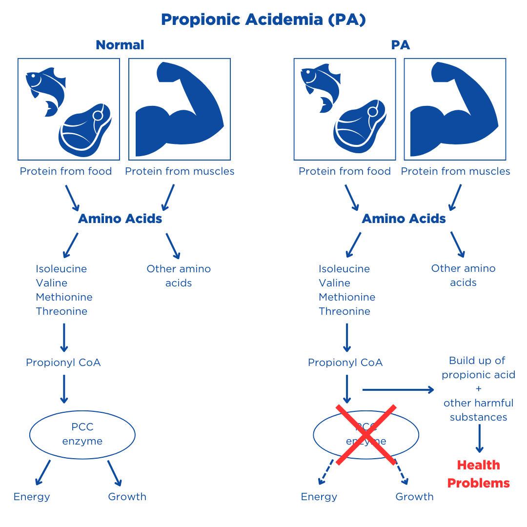 propionic acidemia disease pathway